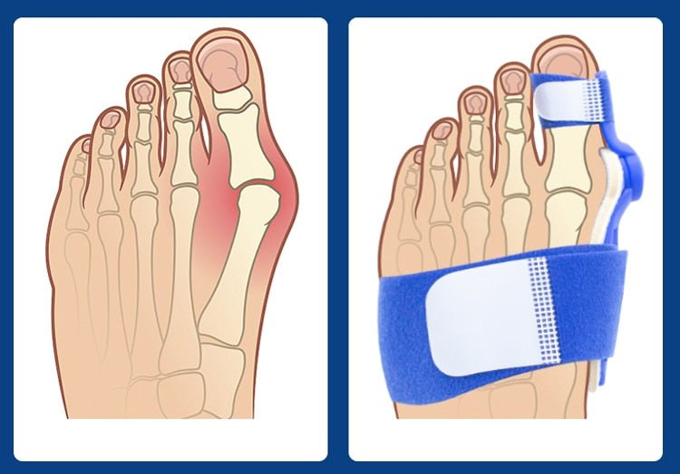 Big Toe Corrector