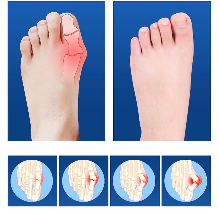 Big Toe Corrector