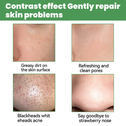 Moisturizing Carbonated Bubble Blackheads Removal