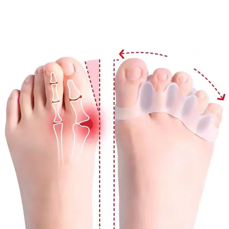 Silicone Hallux Valgus Bunion Corrector