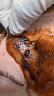 Deep Clean Peel Off Blackhead Removal