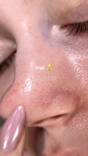 Hydrocolloid Blackheads Removal Nose Patches